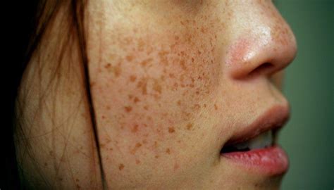freckles         wrvo public