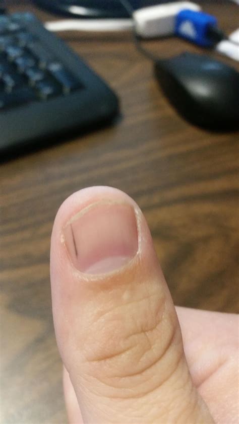 thin black   thumb nail  concerned    askdocs