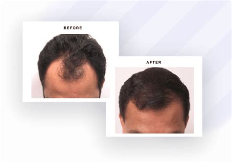 🥇 Hair Loss Restoration Hair Transplant Acworth Atlanta Bubolo