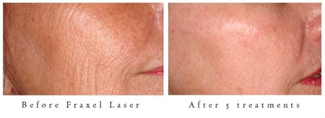 october specials ipl and cynosure emerge fractional laser ipl