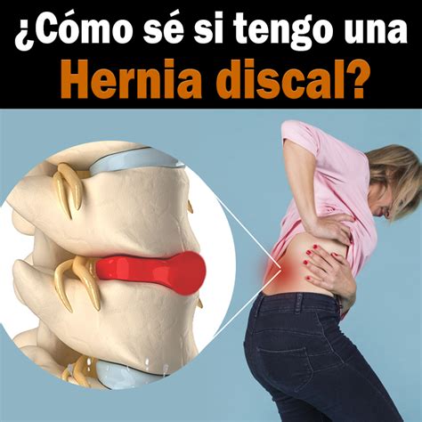 como saber  tu dolor de espalda es por hernia discal cordus mexico