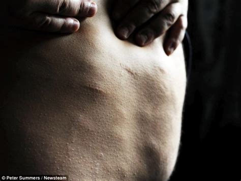 dercum s disease sufferer who s covered in hundreds of balls of fat