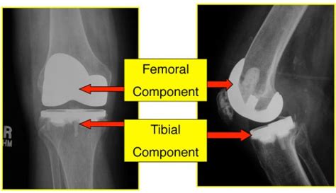 Dr Craig J Della Valle Hip And Knee Surgeon Total Knee
