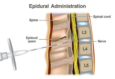 epidural    procedure risks side effects