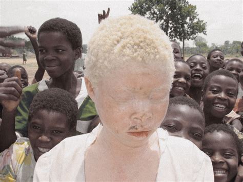 shakaama  african albinos  hacked   body parts