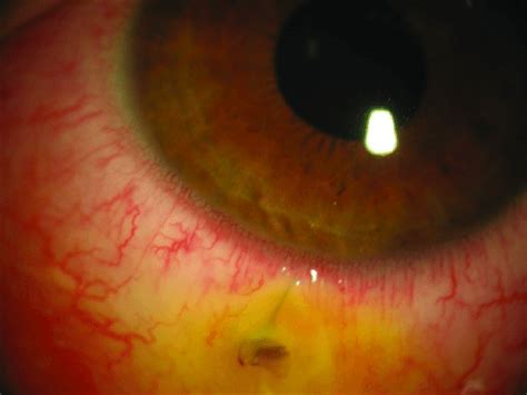 A 22 Year Old Beekeeper With A Conjunctival Bee Sting