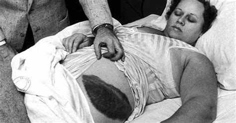 In 1964 This Woman Was Hit By A Meteorite While She Was