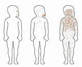 Rash Symptoms Measles Virus Infection Disease Body Diagram Face Human Figure Landscapes Measels Does sketch template