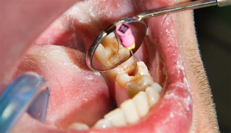 root canal treatment fear  litigation dentistrycouk