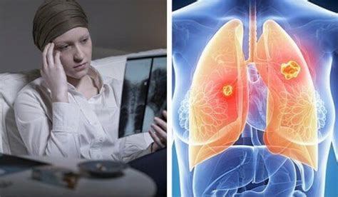Lung Cancer In Women Is Much More Deadly Step To Health