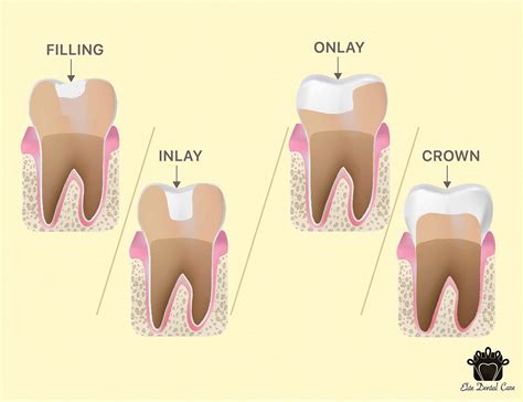 fillings  inlayonlay  crown elite dental care tracy elite