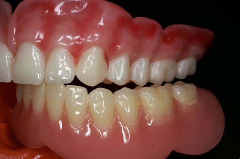 premium partial  full dentures straight   dentists mouthstraight   dentists