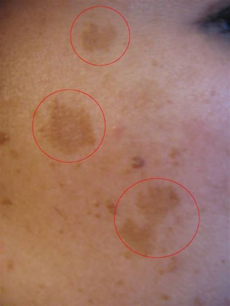 light brown spots appearing  face americanwarmomsorg