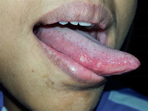 itchy tongue causes symptoms treatments remedies and prevention helpful guides