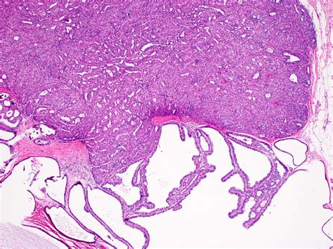 pathology outlines intraductal papilloma