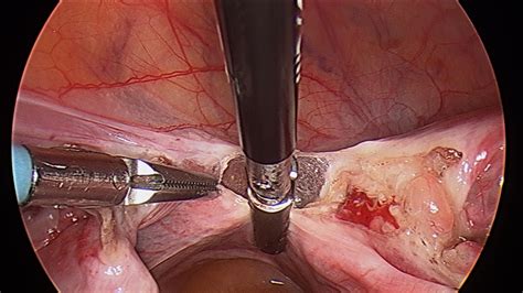 laproscopic supra cervical hysterectomy — wa gynaescope