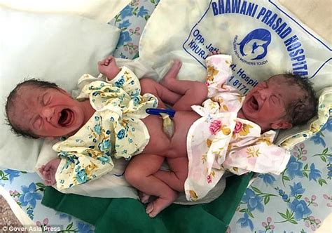 indian mum of conjoined twins told to return to hospital daily mail online