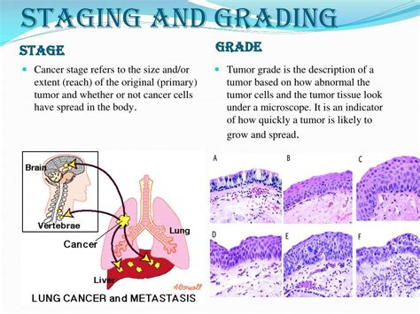 Ppt Lung Cancer Staging Powerpoint Presentation Free Download Id