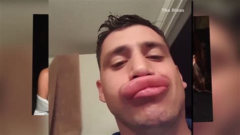 Texas Man Gets Stung By Yellow Jackets On The Lips Puffy Lips Video