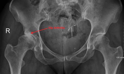 arthritis knee  hip website