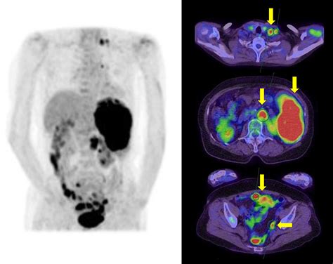 splenic and peritoneal metastases with para aortic and virchow lymph