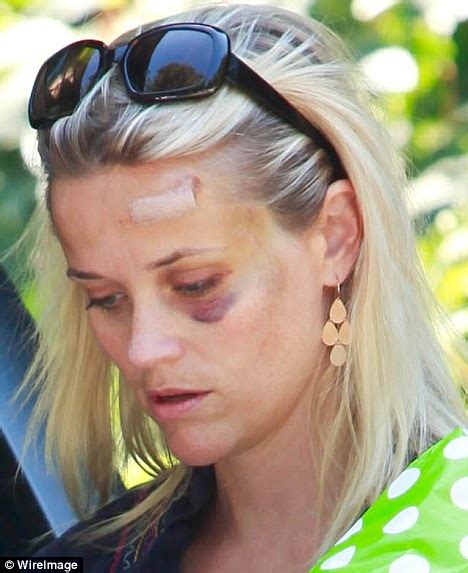 Reese Witherspoon Bruised After Car Accident Actress Reveals Black Eye