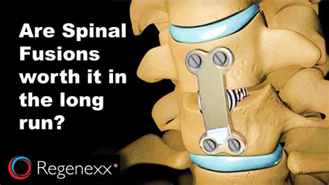 spinal fusion   worth