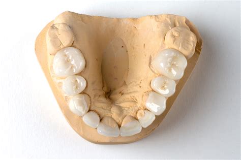 zirconia crown zirconia dental implant pindan dental lab