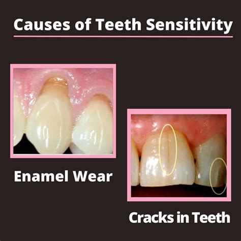 teeth sensitivity causes treatments and home remedies