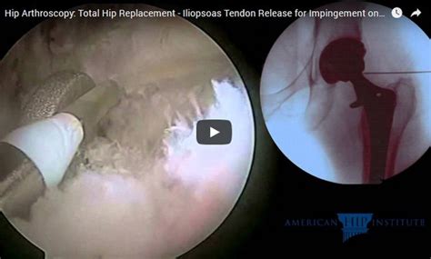 Snapping Hip Syndrome Chicagoland Hip Disoder Treatment Des Plaines