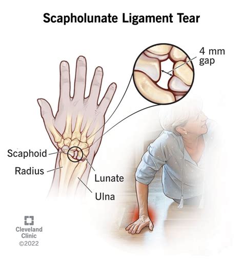 wrist sprains symptoms  treatment