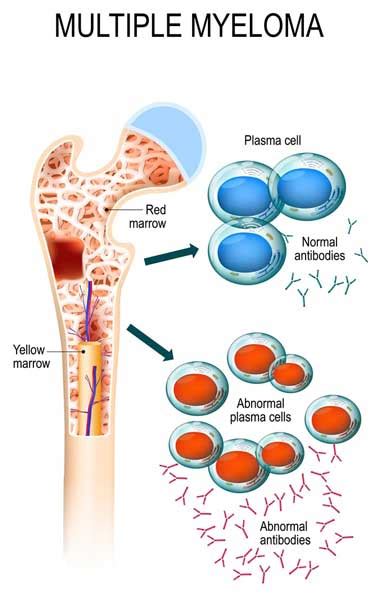 role  genetics   development  multiple myeloma