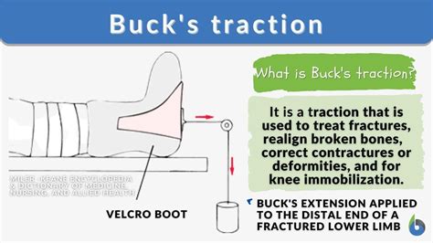 bucks traction definition  examples biology  dictionary