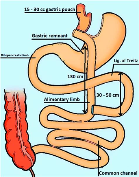 Roux En Y Gastric Bypass Side To Side Jejunojejunostomy