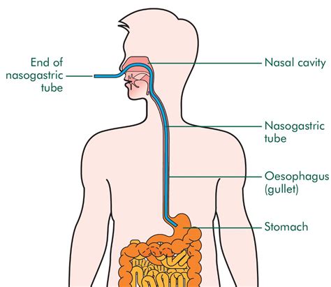 nasogastric feeding tube  symptoms treatment nasogastric