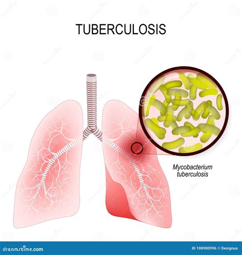 tuberculosis   infection caused  bacteria lungs  infect stock