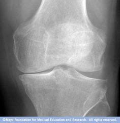 friend arthuritis ideas osteoarthritis knee arthritis
