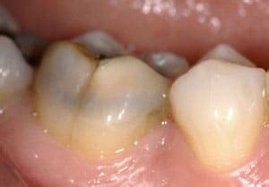 understanding cracked tooth waterford endodontics