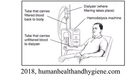 What Are Hemodialysis And Peritoneal Dialysis Youtube