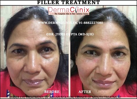 botox and dermal fillers before after photos results image