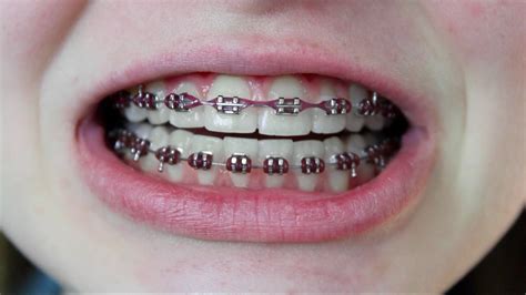 het risico op beugels onderzoek wijst uit dat tandheelkundige correctie niet altijd de