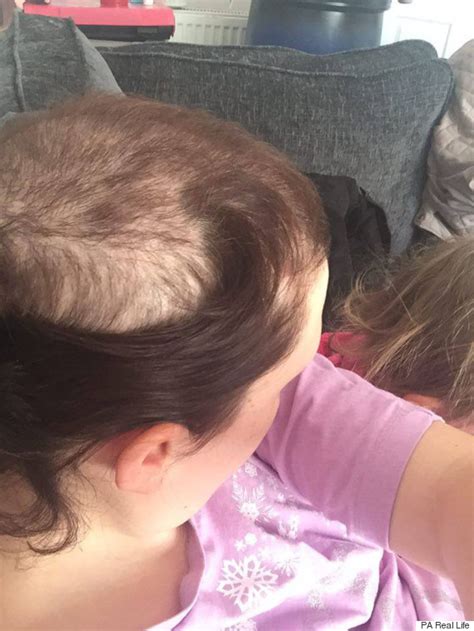 woman has been pulling her own hair out for more than 20 years due to