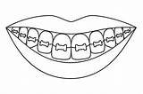 Braces Drawing Teeth Smile Coloring Line Illustrations Vector Clip Tooth Healthy Kids Dentist Stock Dental Illustration sketch template