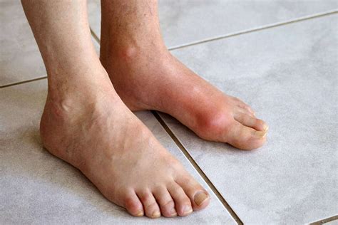 symptoms  gout  foot