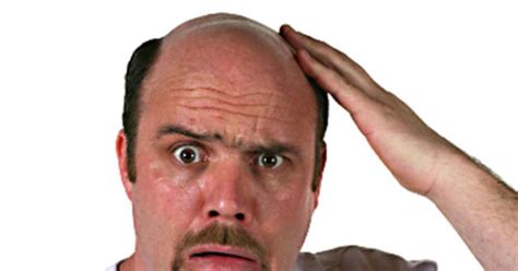is male pattern baldness an early warning sign of prostate cancer