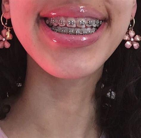 Pin By Mery On Braces Lol Ew Braces Girls Cute Braces Brace Face