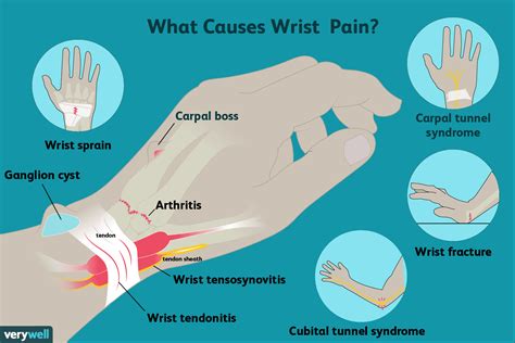wrist pain  symptoms  treatment