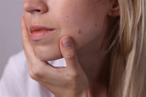here are easy ways to remove skin tags and warts skin
