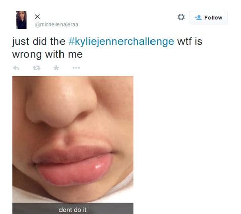 sucking on a bottle lid for bigger lips is a truly terrible idea