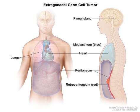 extragonadal germ cell tumors treatment pdq® —patient version